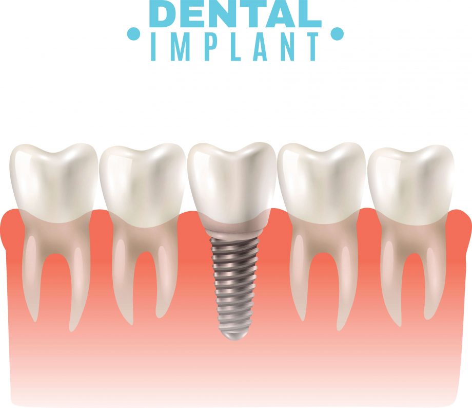 graphic of a single tooth dental implant