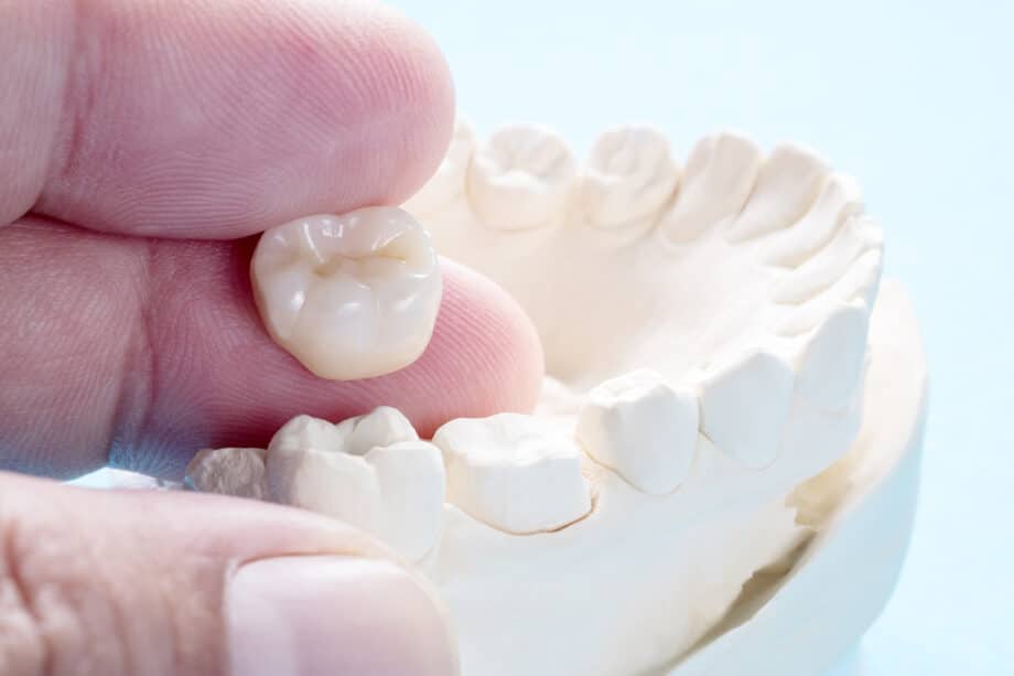 Dental Crowns vs. Fillings: How Dentists Decide Which You Need