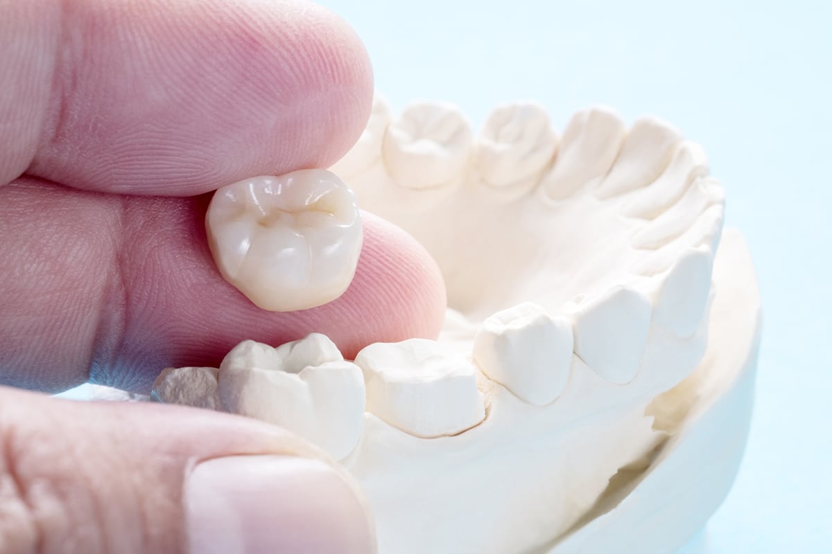 Dental Crowns vs. Fillings: How Dentists Decide Which You Need