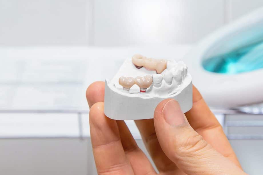 How Long Does It Take For A Dental Bridge To Settle?