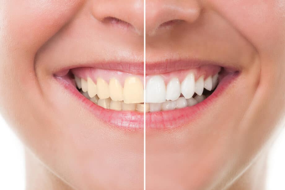 How to Choose the Right Shade for Teeth Whitening