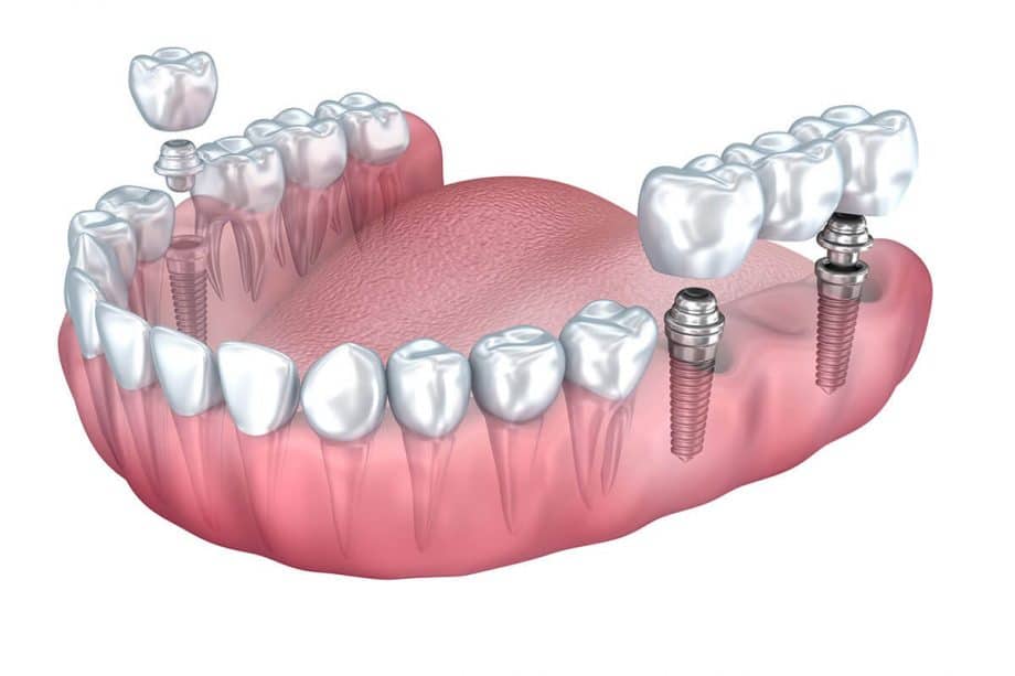 model of different kinds of implants & bridges