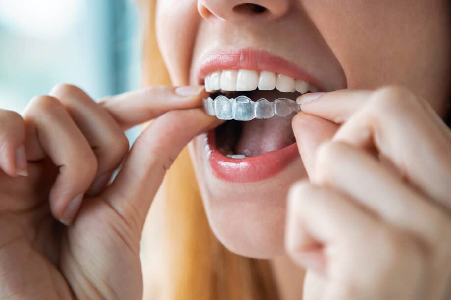 Invisalign vs. Braces: Which Is More Comfortable for Adults?