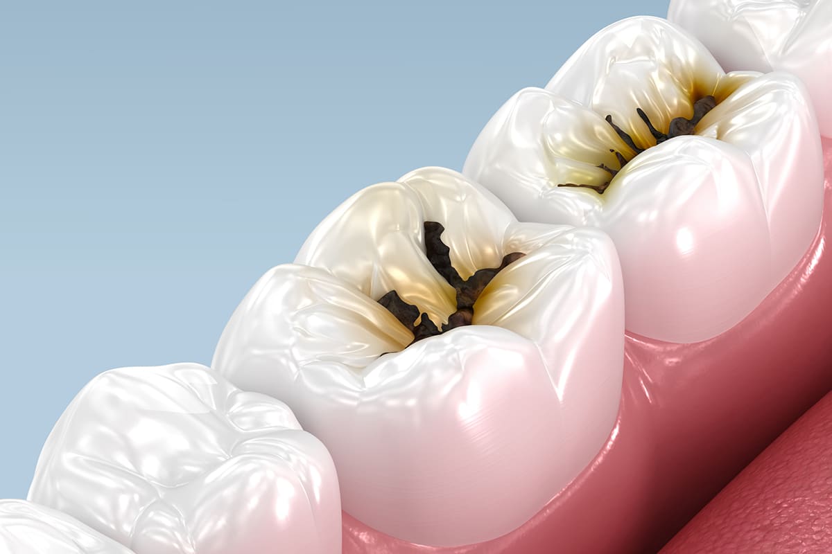 What Happens If You Ignore a Cavity?